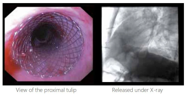 covered esophageal stents