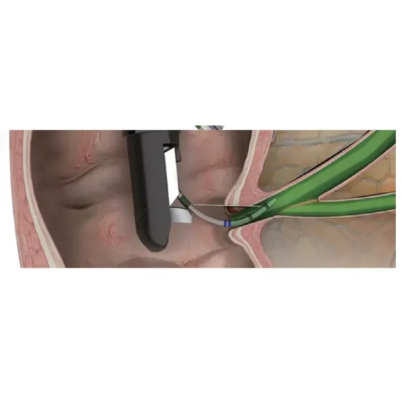 sphincterotome or short wire compatible for precise wire guidance and cannulation 5 580x580